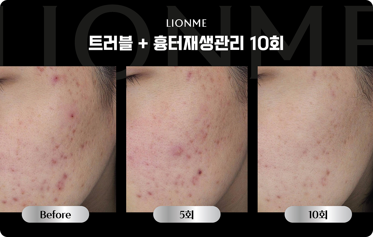 트러블 + 흉터재생관리 10회