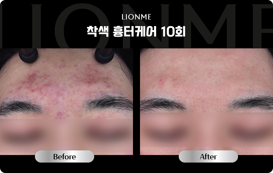 착색 흉터케어 10회