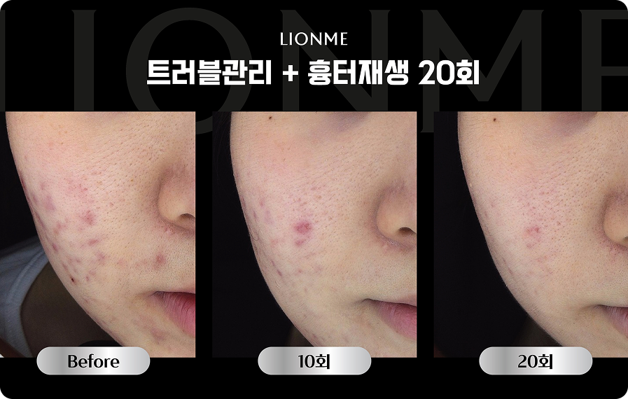 트러블관리 + 흉터재생 20회