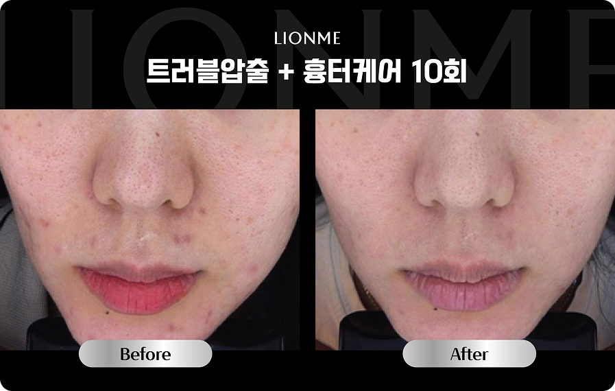 트러블압출 + 흉터케어 10회