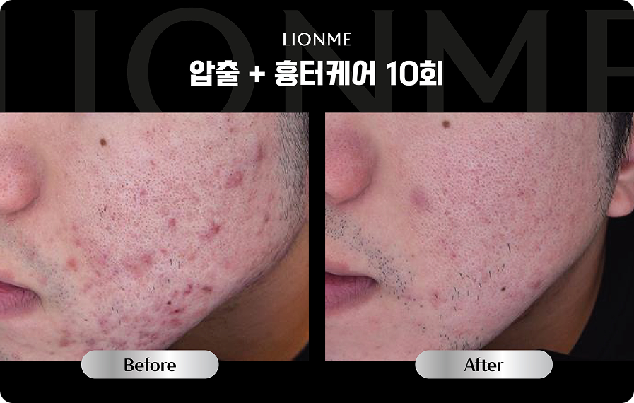압출 + 흉터케어 10회