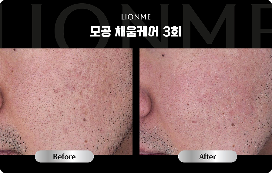 모공 채움케어 3회