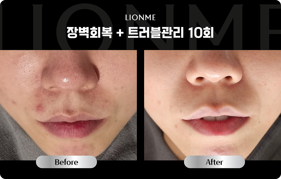 장벽회복 + 트러블관리 10회