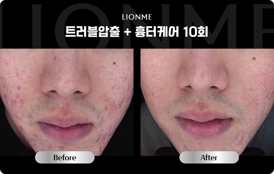 트러블압축 + 흉터케어 10회
