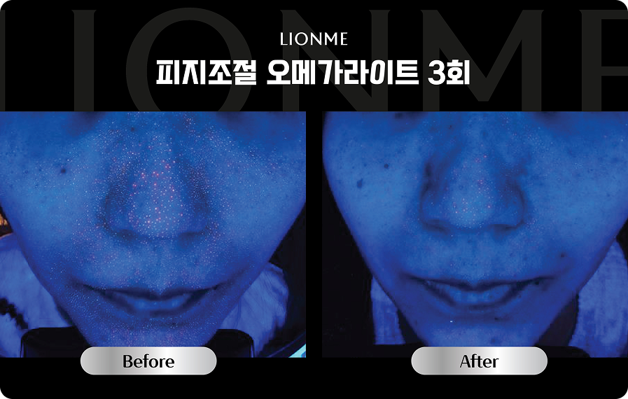 피지조절 오메가라이트 3회